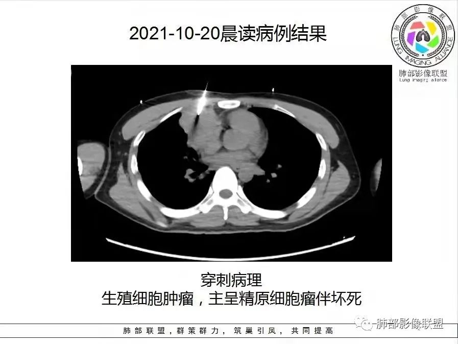 影像PPT - 【病例】前纵隔精原细胞瘤1例CT-13 影像PPT - 【病例】前纵隔精原细胞瘤1例CT-13