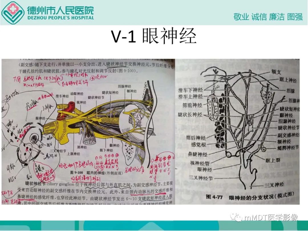 影像PPT - 【PPT】绕出崎岖孔孔道—三叉神经的颅底走形-12