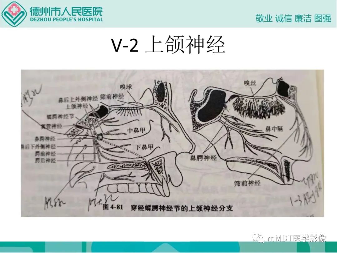 影像PPT - 【PPT】绕出崎岖孔孔道—三叉神经的颅底走形-18