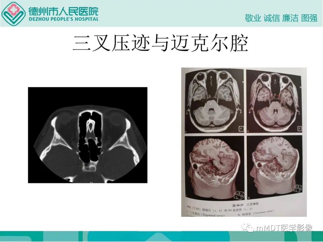 影像PPT - 【PPT】绕出崎岖孔孔道—三叉神经的颅底走形-28