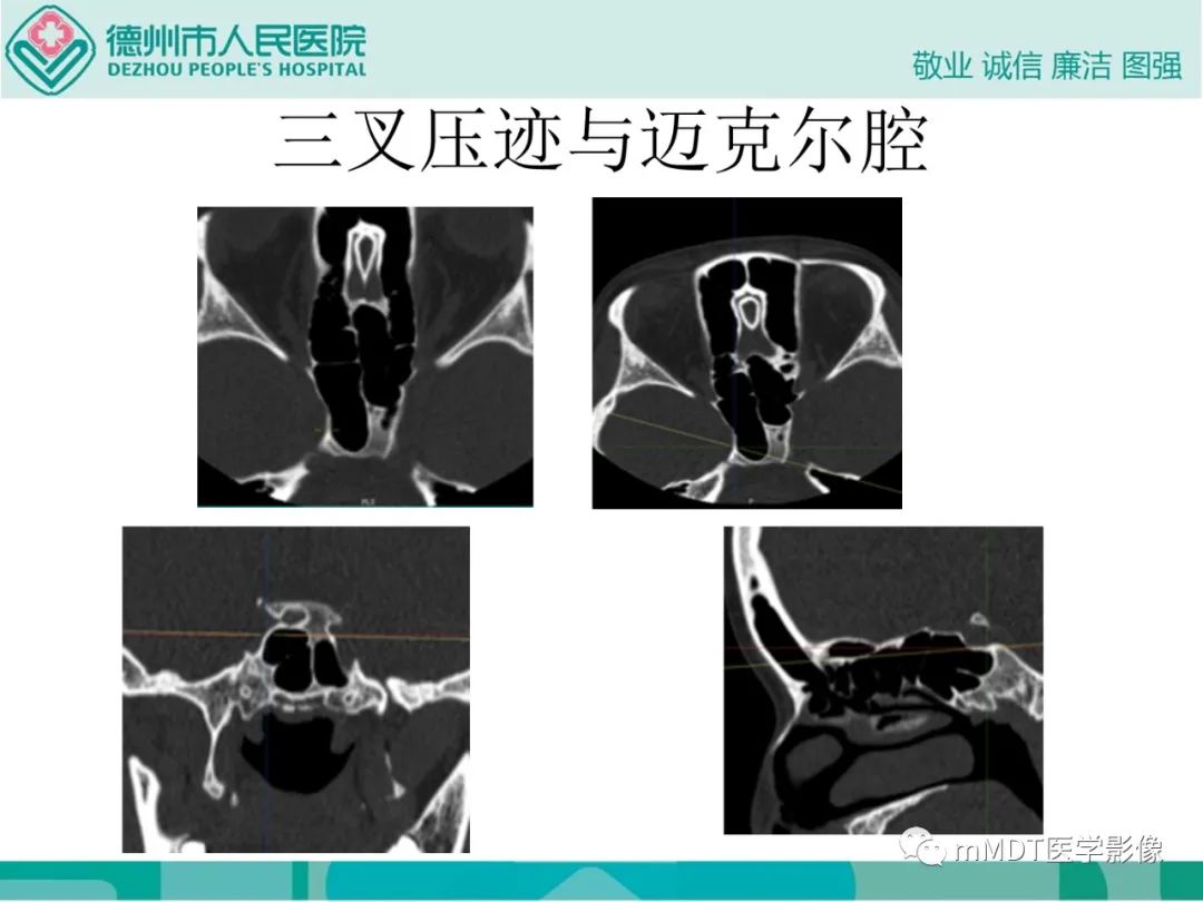 影像PPT - 【PPT】绕出崎岖孔孔道—三叉神经的颅底走形-29
