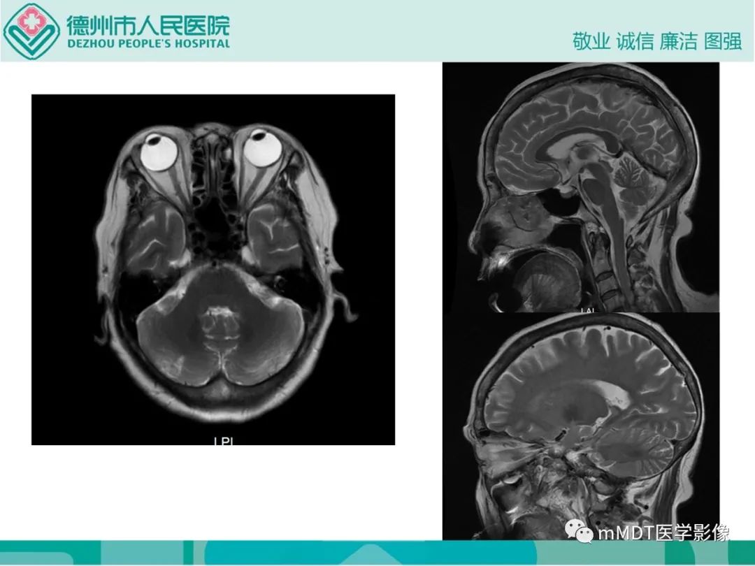 影像PPT - 【PPT】绕出崎岖孔孔道—三叉神经的颅底走形-30