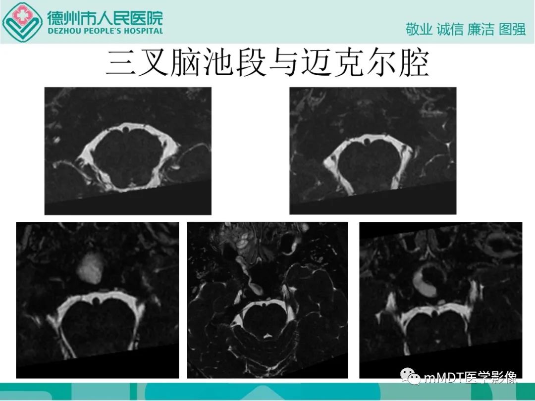 影像PPT - 【PPT】绕出崎岖孔孔道—三叉神经的颅底走形-31