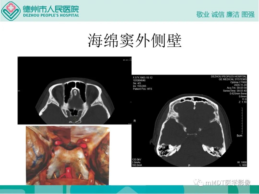 影像PPT - 【PPT】绕出崎岖孔孔道—三叉神经的颅底走形-32