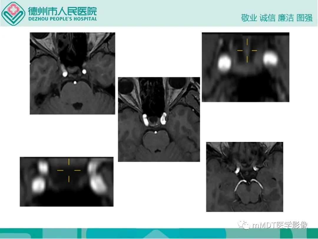 影像PPT - 【PPT】绕出崎岖孔孔道—三叉神经的颅底走形-33
