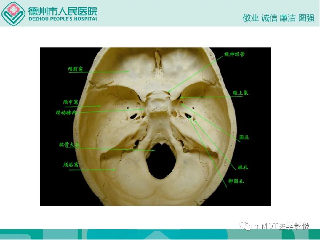 影像PPT - 【PPT】绕出崎岖孔孔道—三叉神经的颅底走形-35