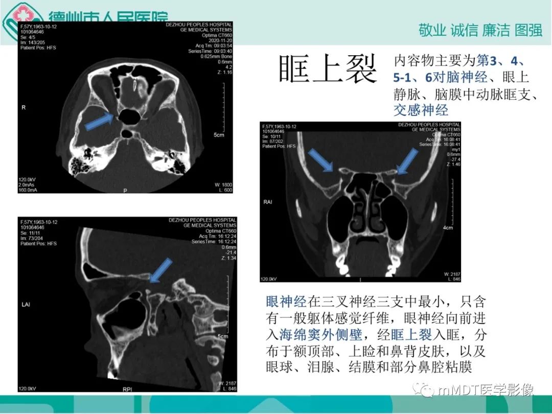 影像PPT - 【PPT】绕出崎岖孔孔道—三叉神经的颅底走形-36