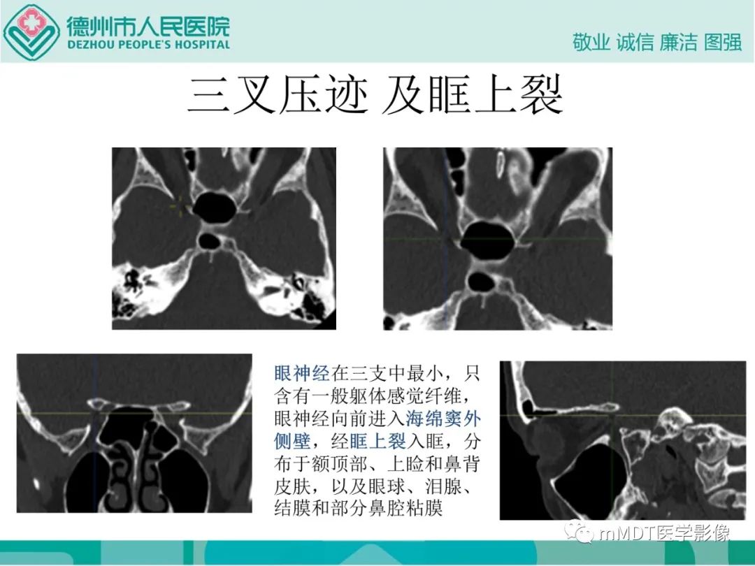 影像PPT - 【PPT】绕出崎岖孔孔道—三叉神经的颅底走形-37