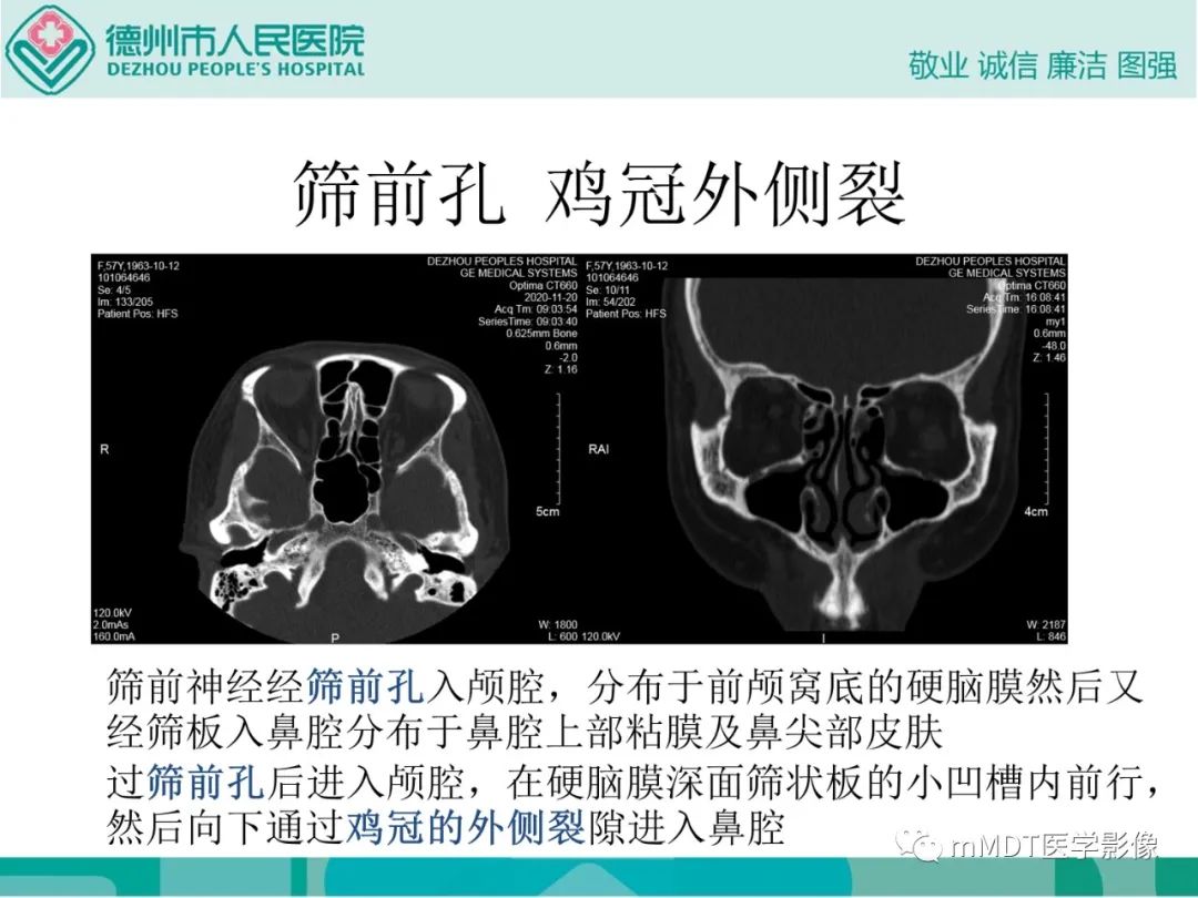 影像PPT - 【PPT】绕出崎岖孔孔道—三叉神经的颅底走形-38