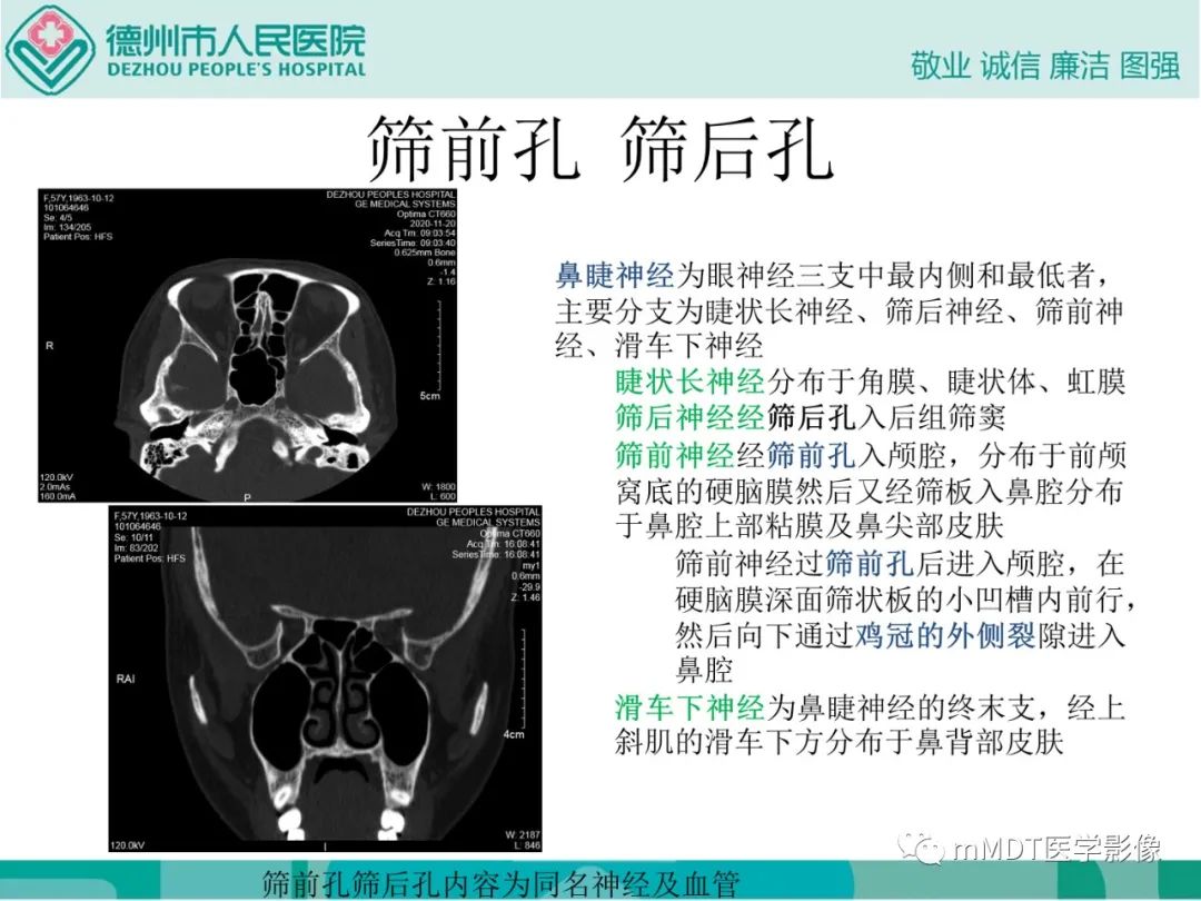 影像PPT - 【PPT】绕出崎岖孔孔道—三叉神经的颅底走形-39