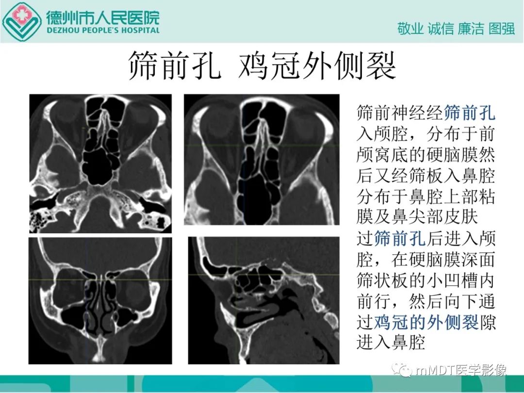 影像PPT - 【PPT】绕出崎岖孔孔道—三叉神经的颅底走形-40