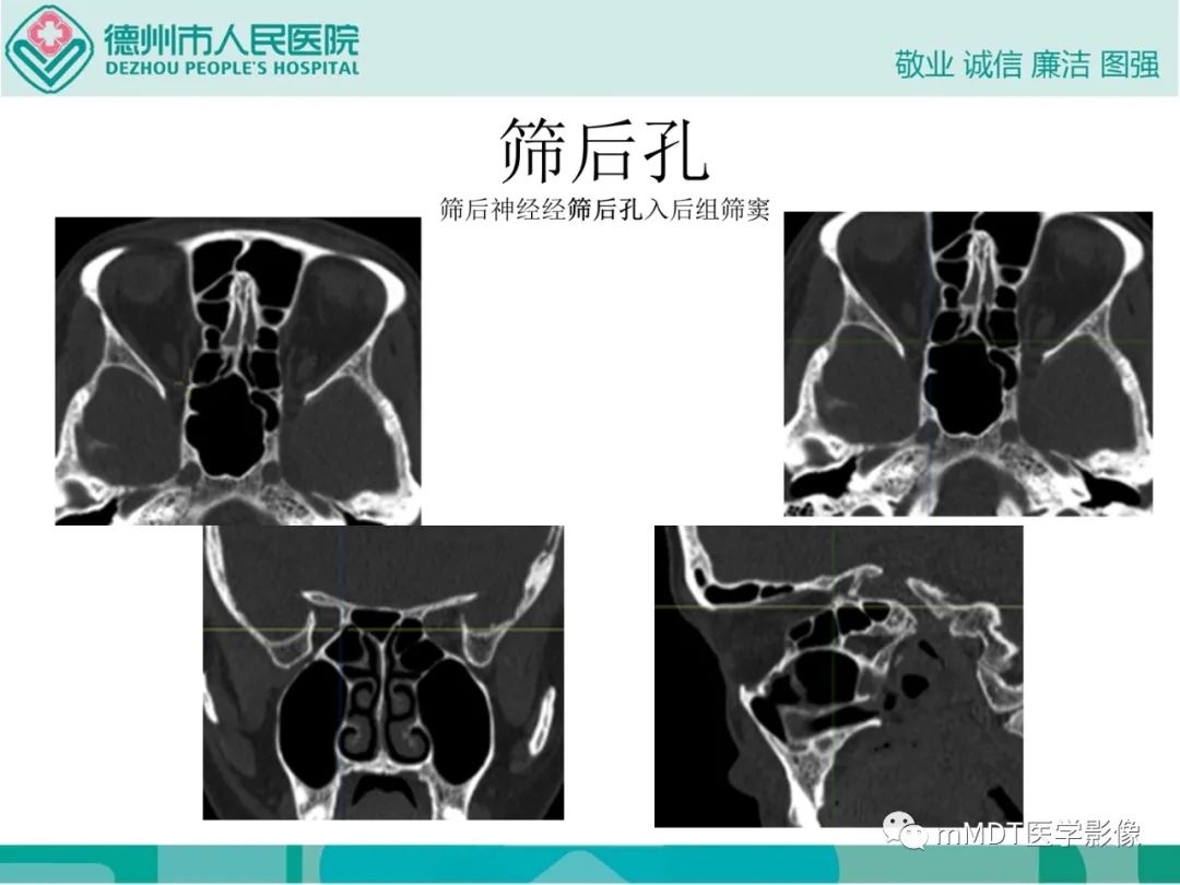 影像PPT - 【PPT】绕出崎岖孔孔道—三叉神经的颅底走形-41