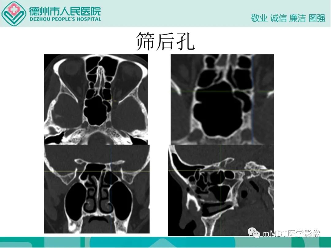 影像PPT - 【PPT】绕出崎岖孔孔道—三叉神经的颅底走形-42