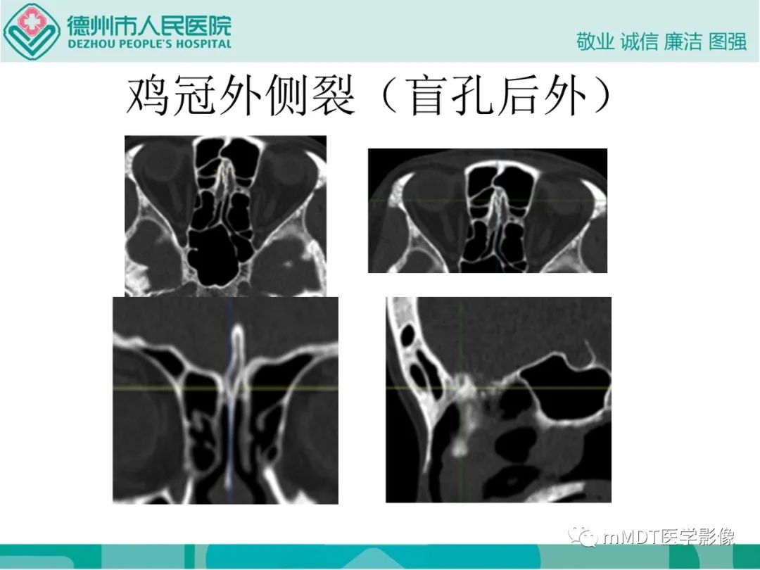 影像PPT - 【PPT】绕出崎岖孔孔道—三叉神经的颅底走形-43