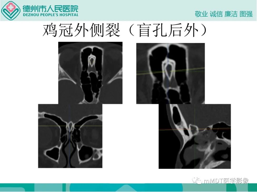 影像PPT - 【PPT】绕出崎岖孔孔道—三叉神经的颅底走形-44