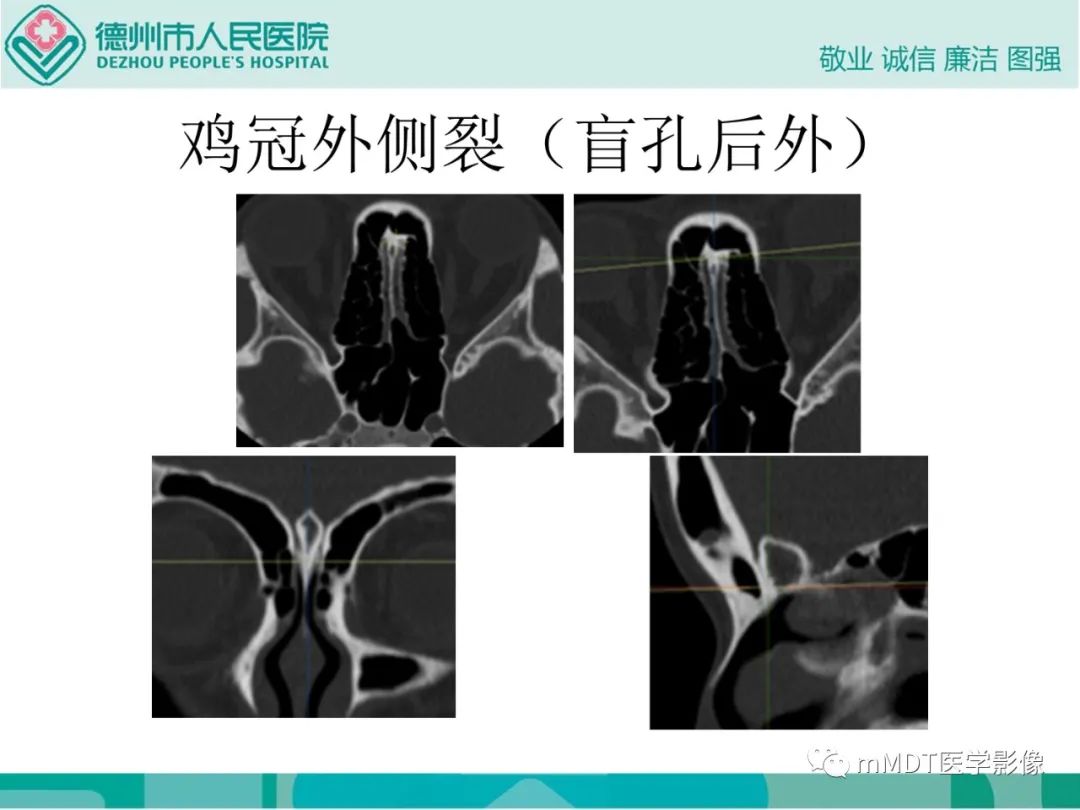影像PPT - 【PPT】绕出崎岖孔孔道—三叉神经的颅底走形-45