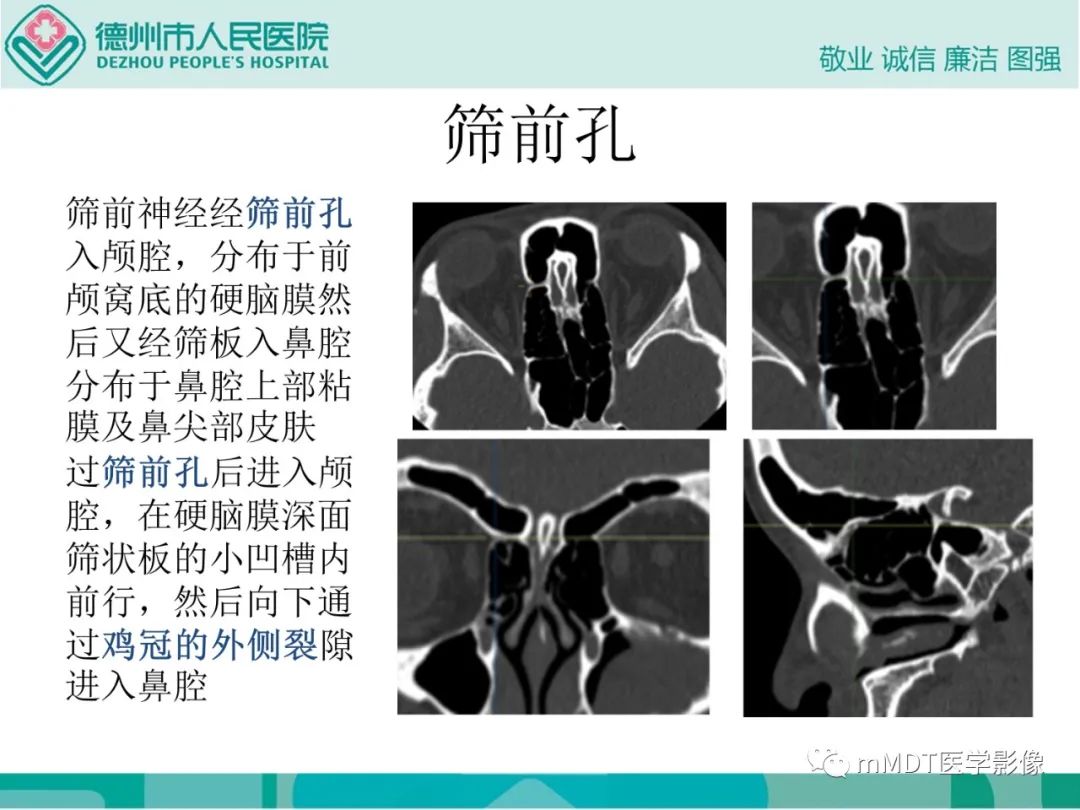 影像PPT - 【PPT】绕出崎岖孔孔道—三叉神经的颅底走形-46