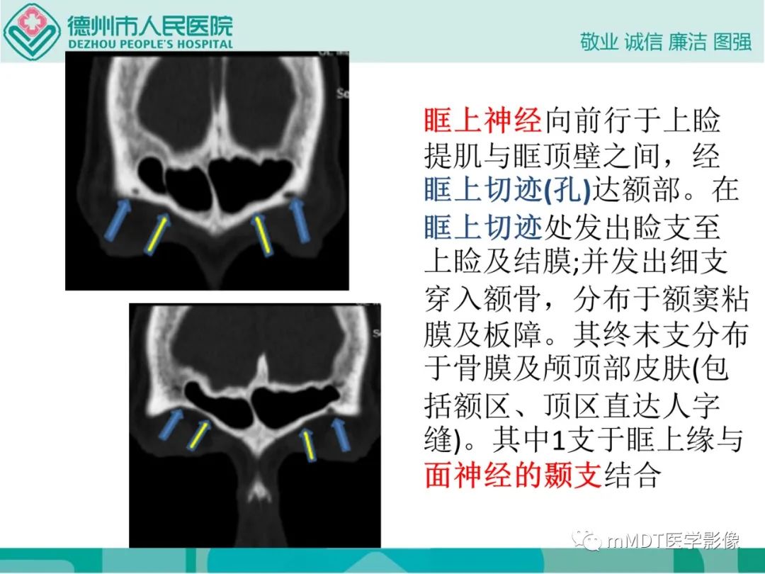 影像PPT - 【PPT】绕出崎岖孔孔道—三叉神经的颅底走形-49