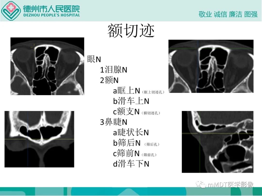 影像PPT - 【PPT】绕出崎岖孔孔道—三叉神经的颅底走形-50
