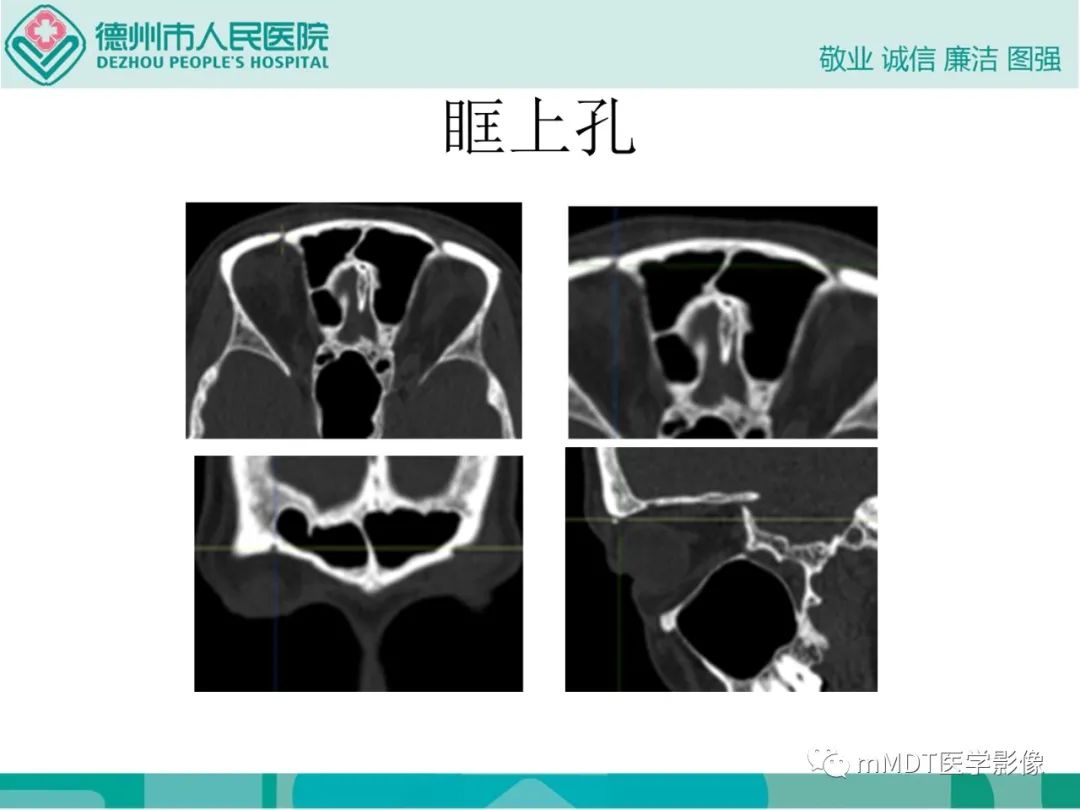 影像PPT - 【PPT】绕出崎岖孔孔道—三叉神经的颅底走形-51