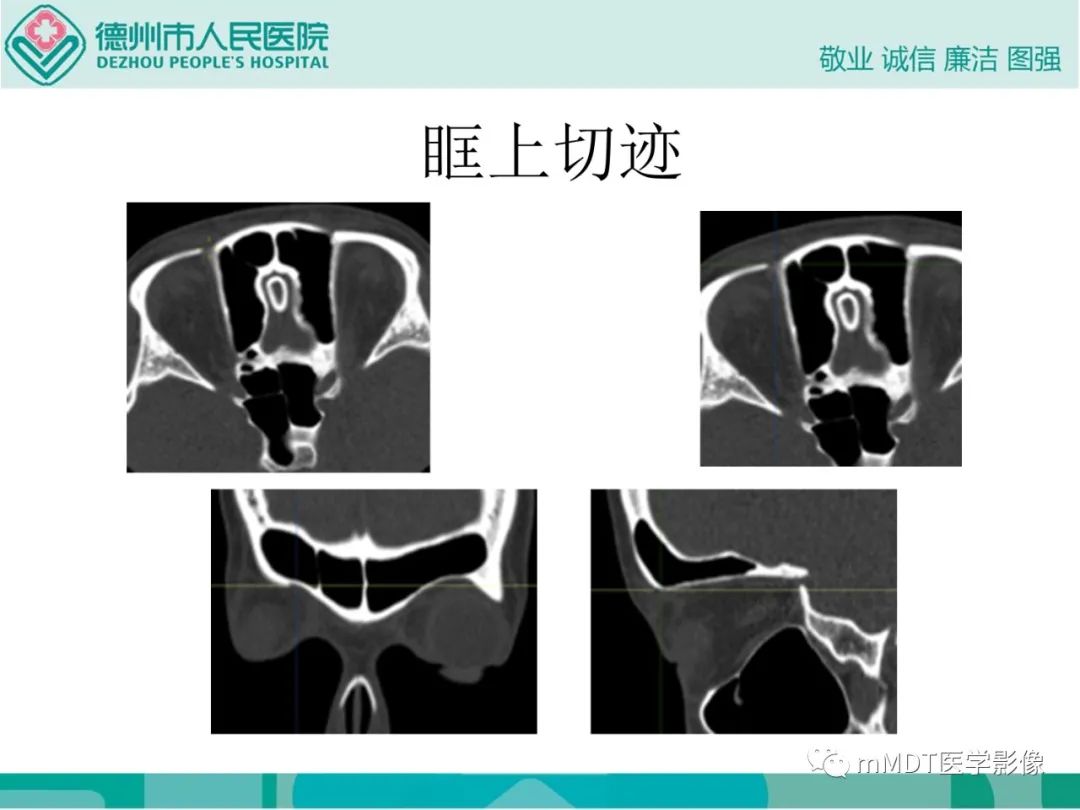 影像PPT - 【PPT】绕出崎岖孔孔道—三叉神经的颅底走形-52