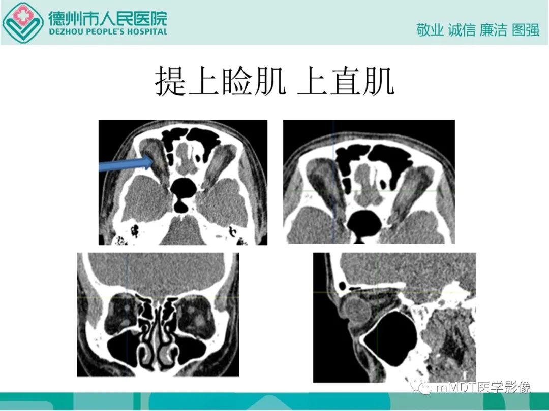 影像PPT - 【PPT】绕出崎岖孔孔道—三叉神经的颅底走形-53
