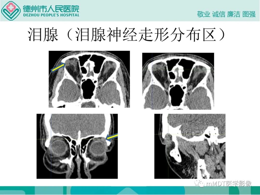 影像PPT - 【PPT】绕出崎岖孔孔道—三叉神经的颅底走形-54