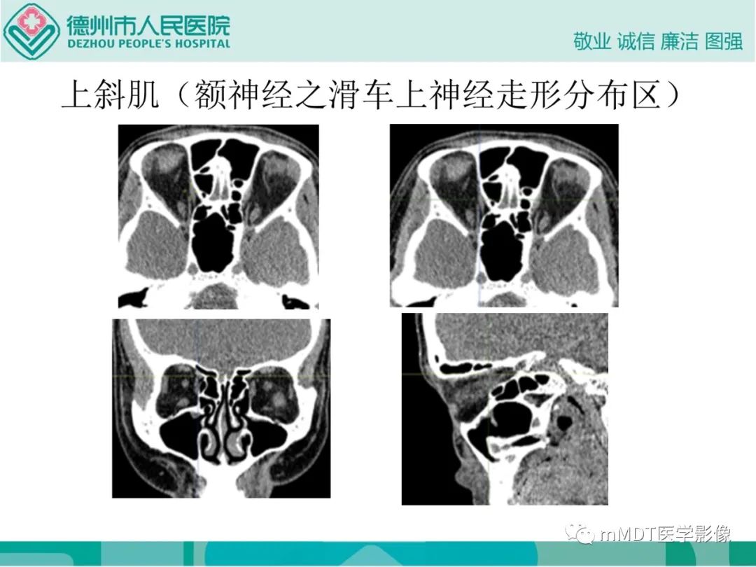 影像PPT - 【PPT】绕出崎岖孔孔道—三叉神经的颅底走形-55