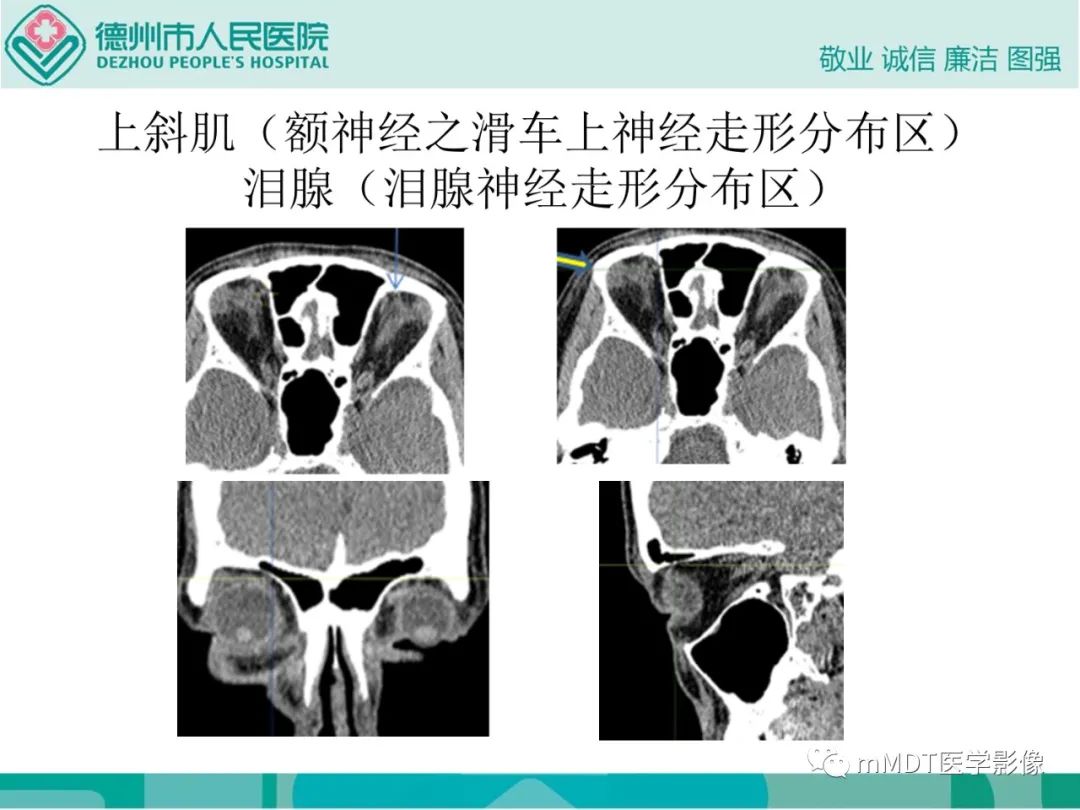 影像PPT - 【PPT】绕出崎岖孔孔道—三叉神经的颅底走形-56