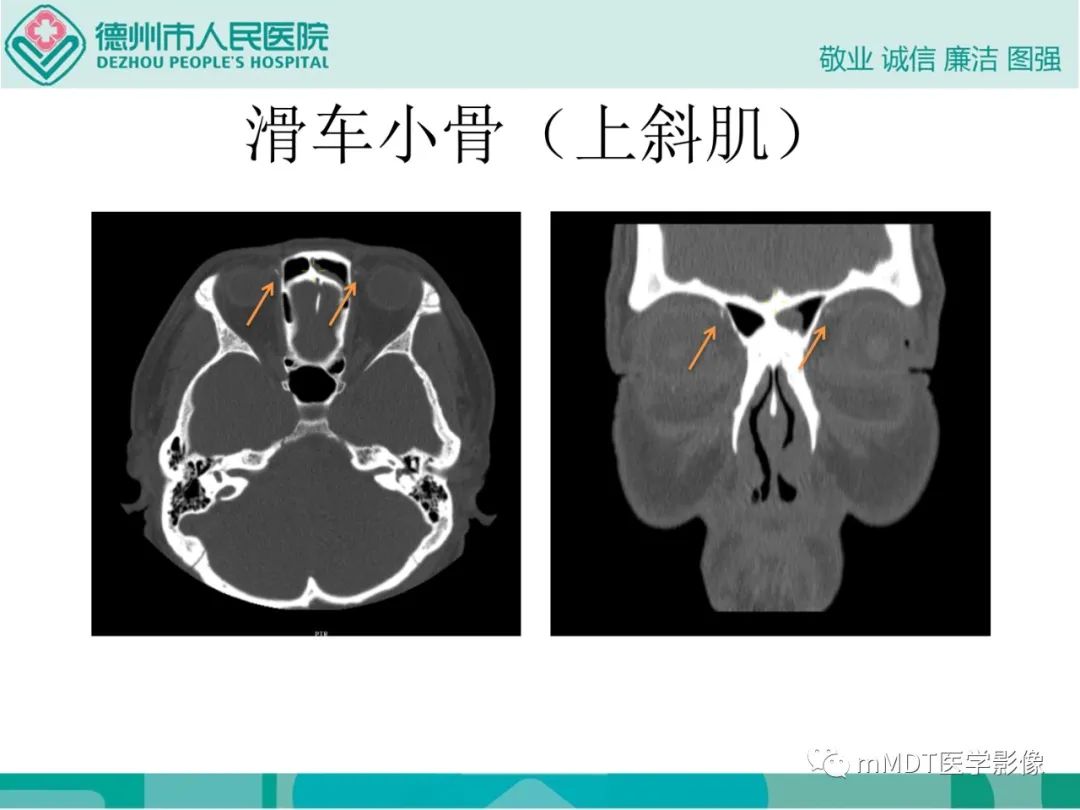 影像PPT - 【PPT】绕出崎岖孔孔道—三叉神经的颅底走形-57