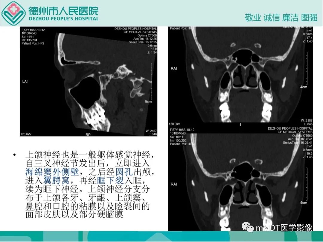 影像PPT - 【PPT】绕出崎岖孔孔道—三叉神经的颅底走形-60