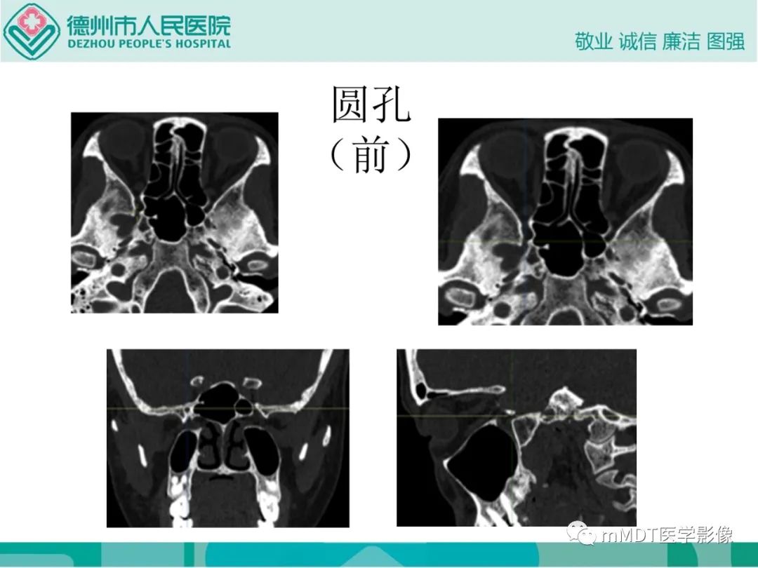 影像PPT - 【PPT】绕出崎岖孔孔道—三叉神经的颅底走形-61