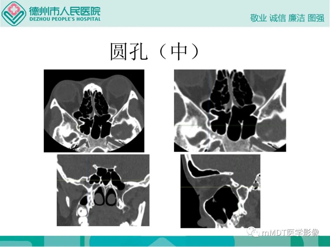 影像PPT - 【PPT】绕出崎岖孔孔道—三叉神经的颅底走形-62