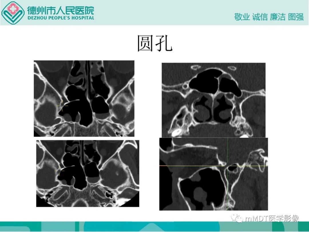 影像PPT - 【PPT】绕出崎岖孔孔道—三叉神经的颅底走形-63
