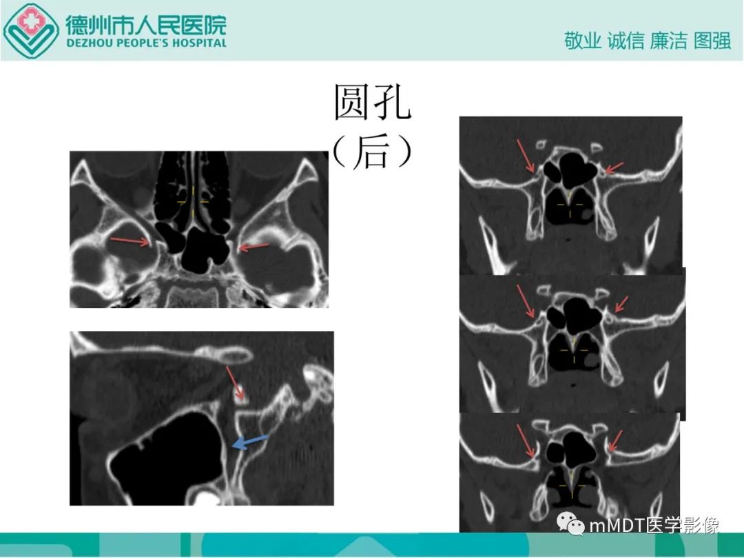 影像PPT - 【PPT】绕出崎岖孔孔道—三叉神经的颅底走形-64