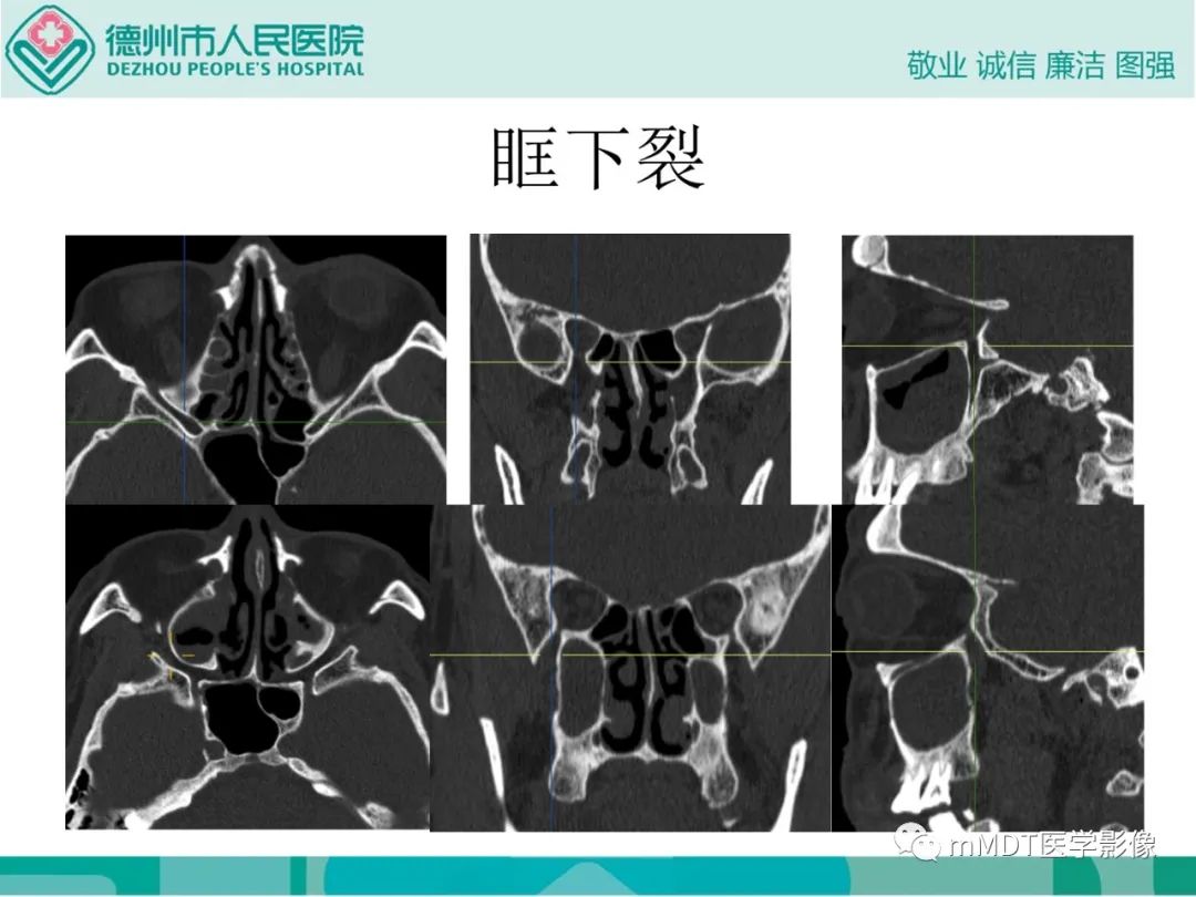 影像PPT - 【PPT】绕出崎岖孔孔道—三叉神经的颅底走形-66