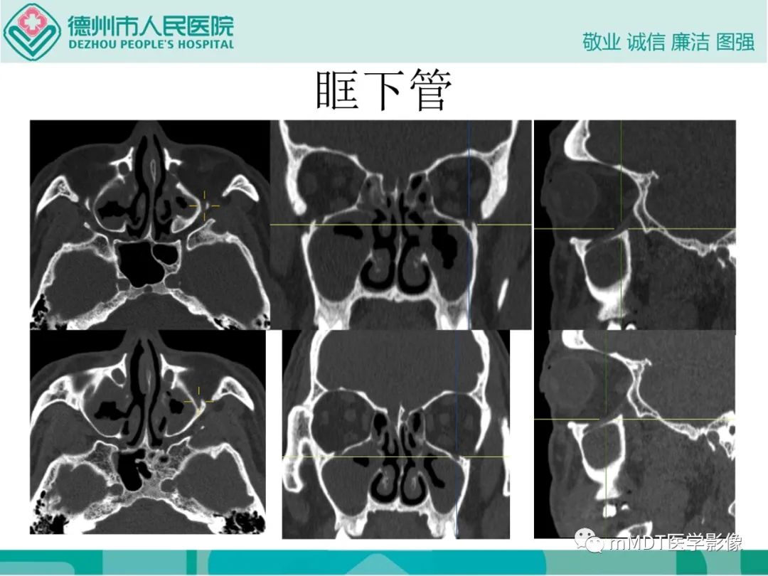 影像PPT - 【PPT】绕出崎岖孔孔道—三叉神经的颅底走形-67