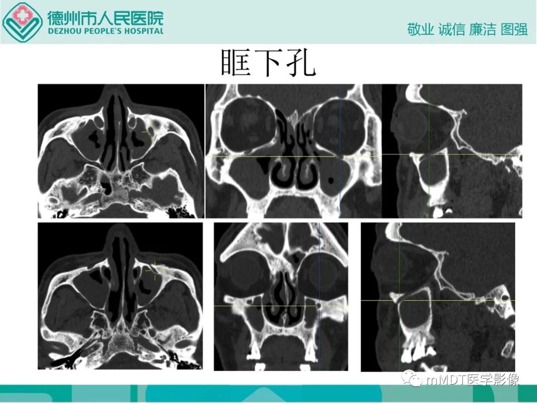影像PPT - 【PPT】绕出崎岖孔孔道—三叉神经的颅底走形-68