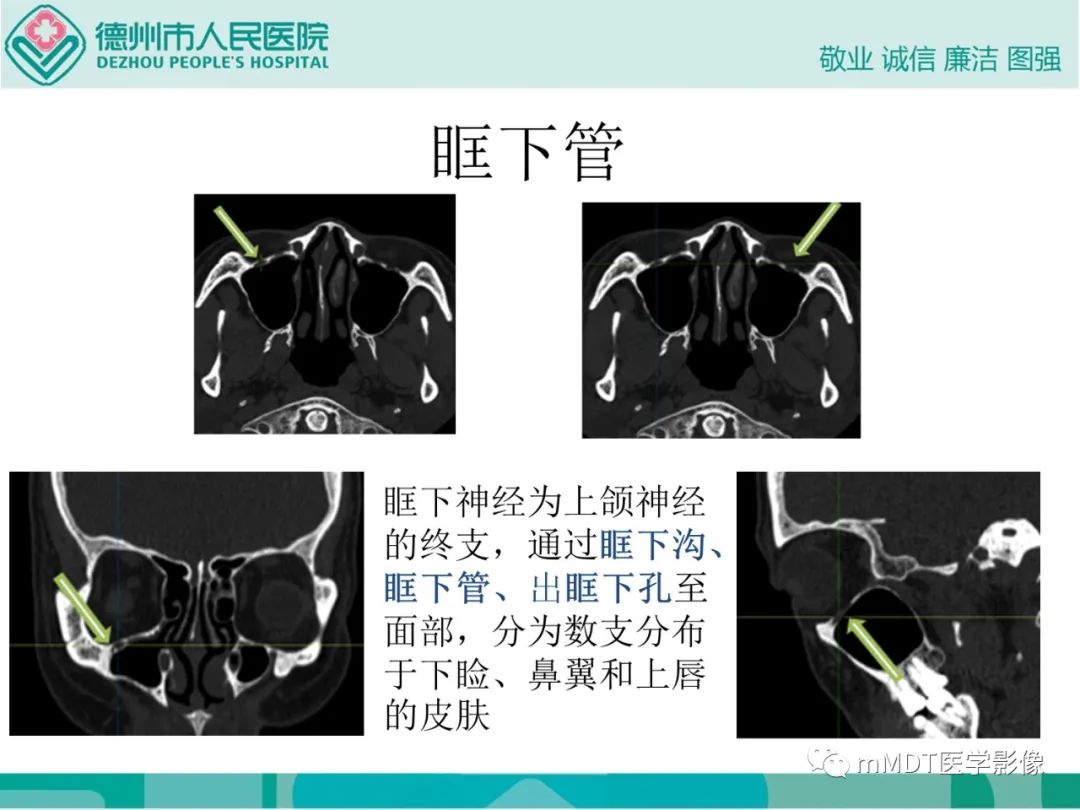 影像PPT - 【PPT】绕出崎岖孔孔道—三叉神经的颅底走形-72