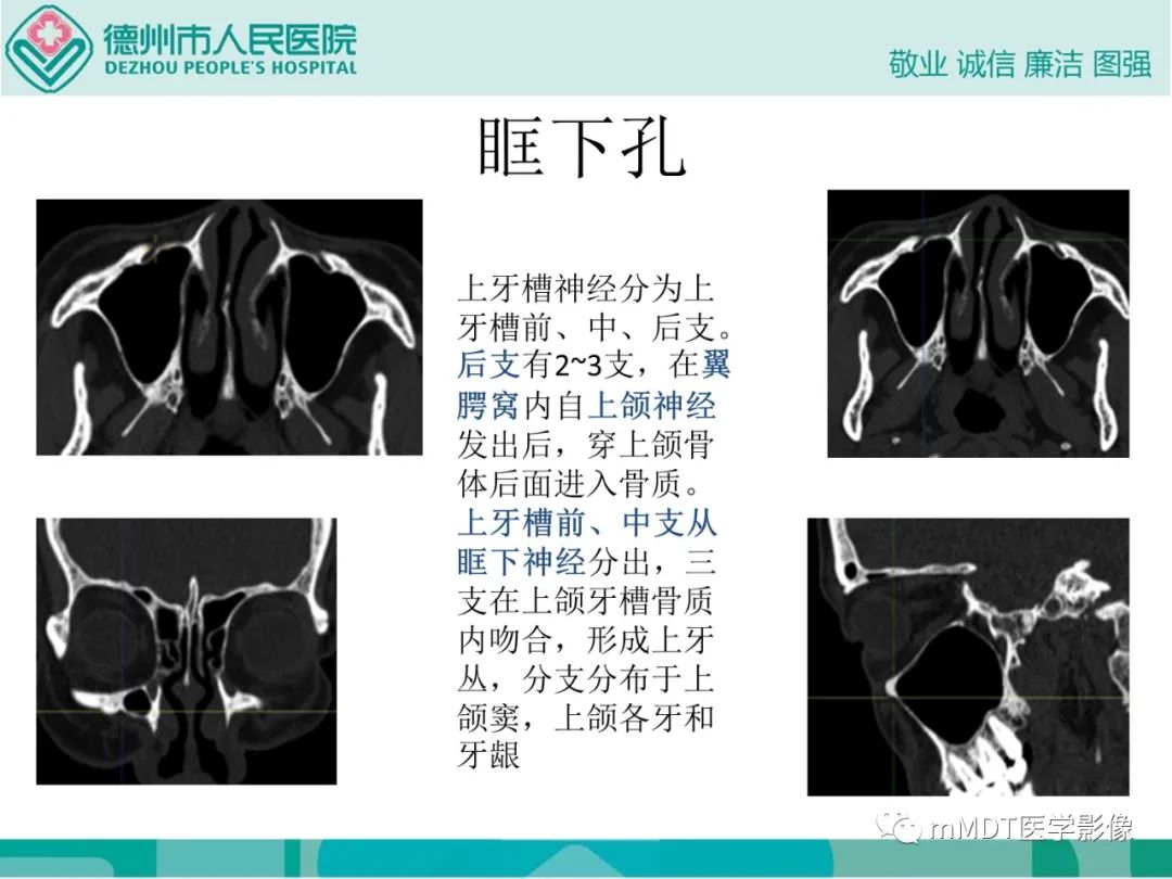 影像PPT - 【PPT】绕出崎岖孔孔道—三叉神经的颅底走形-73