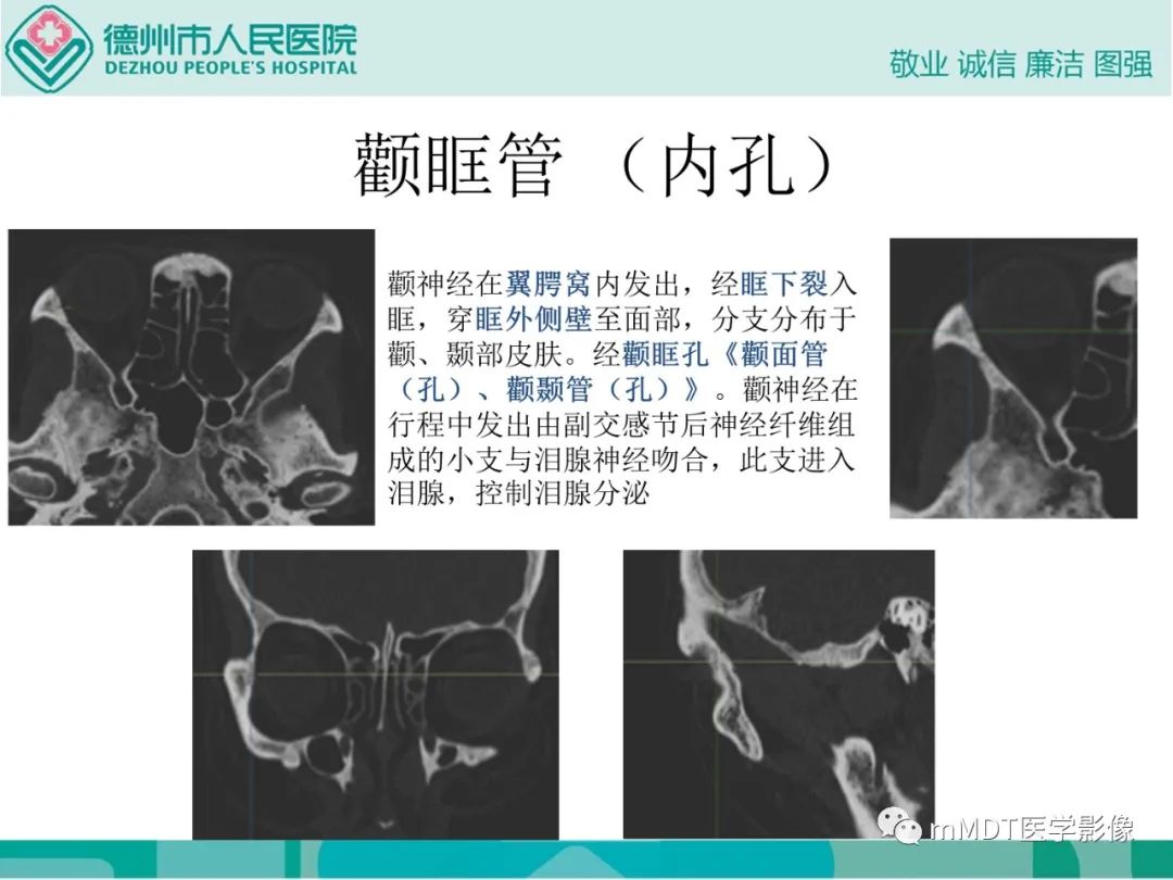 影像PPT - 【PPT】绕出崎岖孔孔道—三叉神经的颅底走形-74