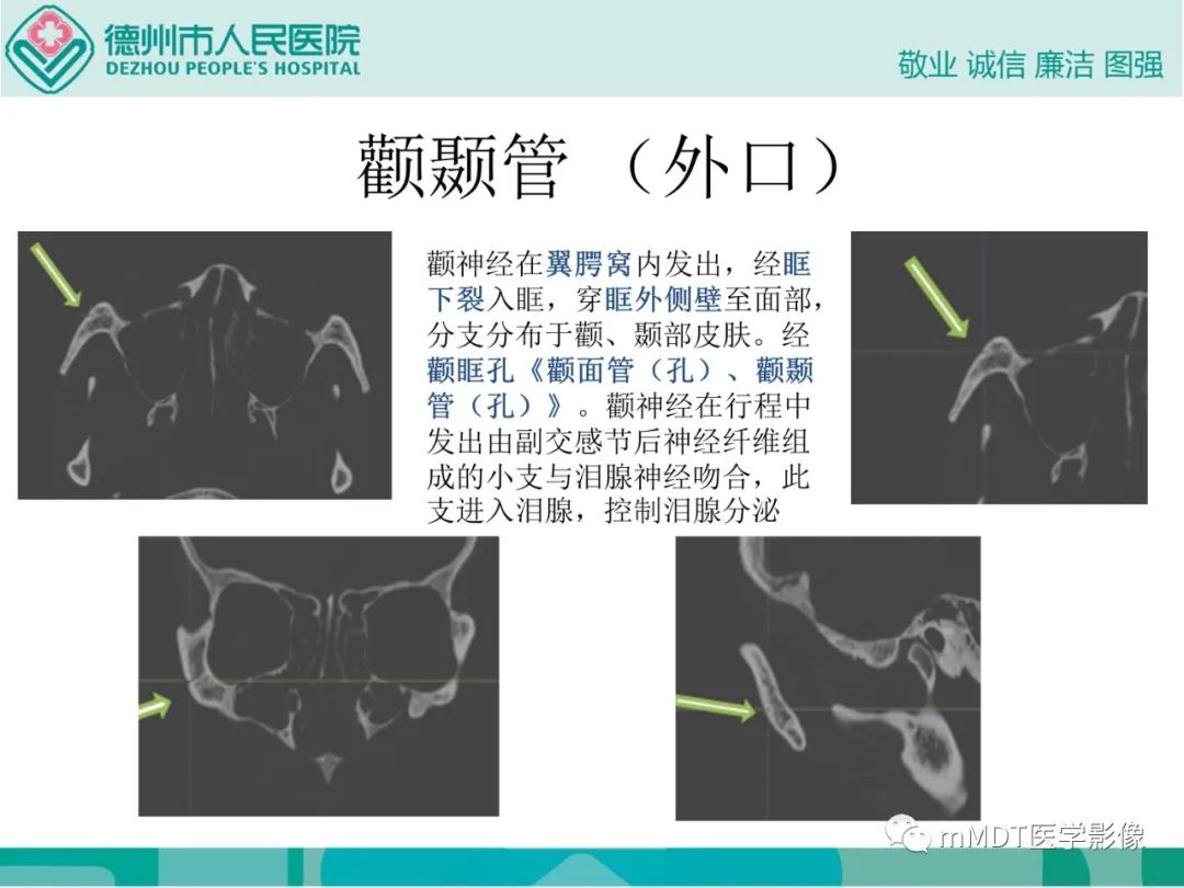 影像PPT - 【PPT】绕出崎岖孔孔道—三叉神经的颅底走形-75