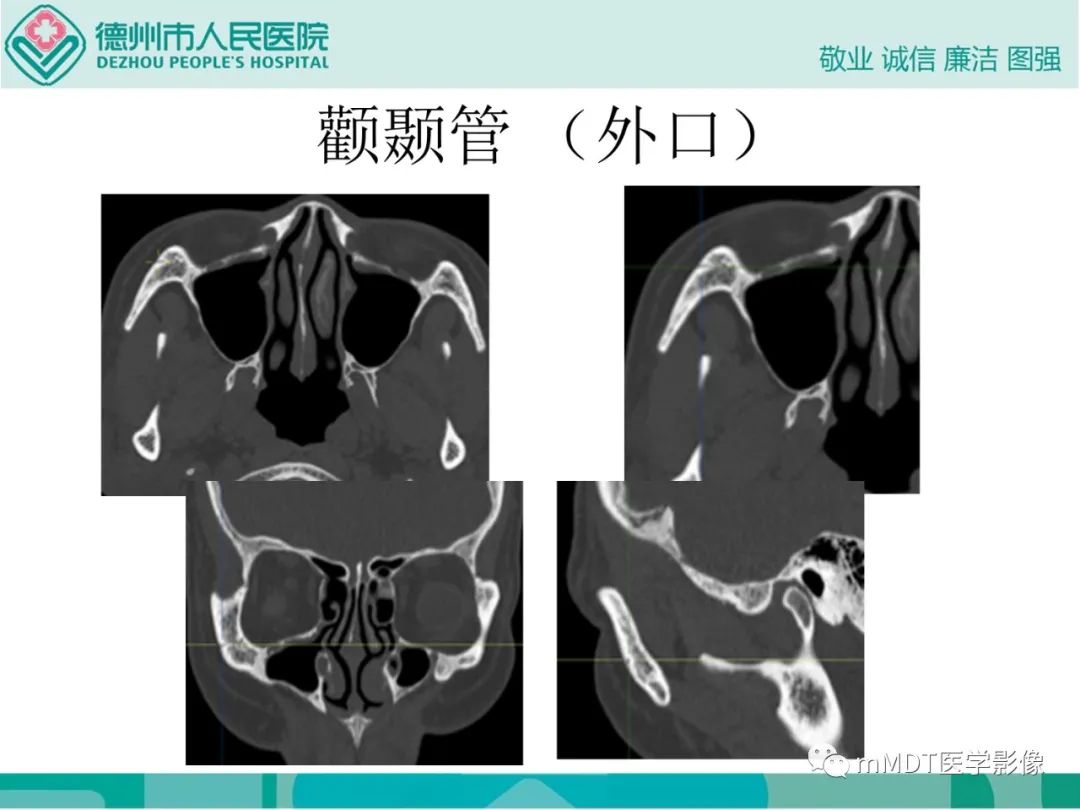 影像PPT - 【PPT】绕出崎岖孔孔道—三叉神经的颅底走形-76