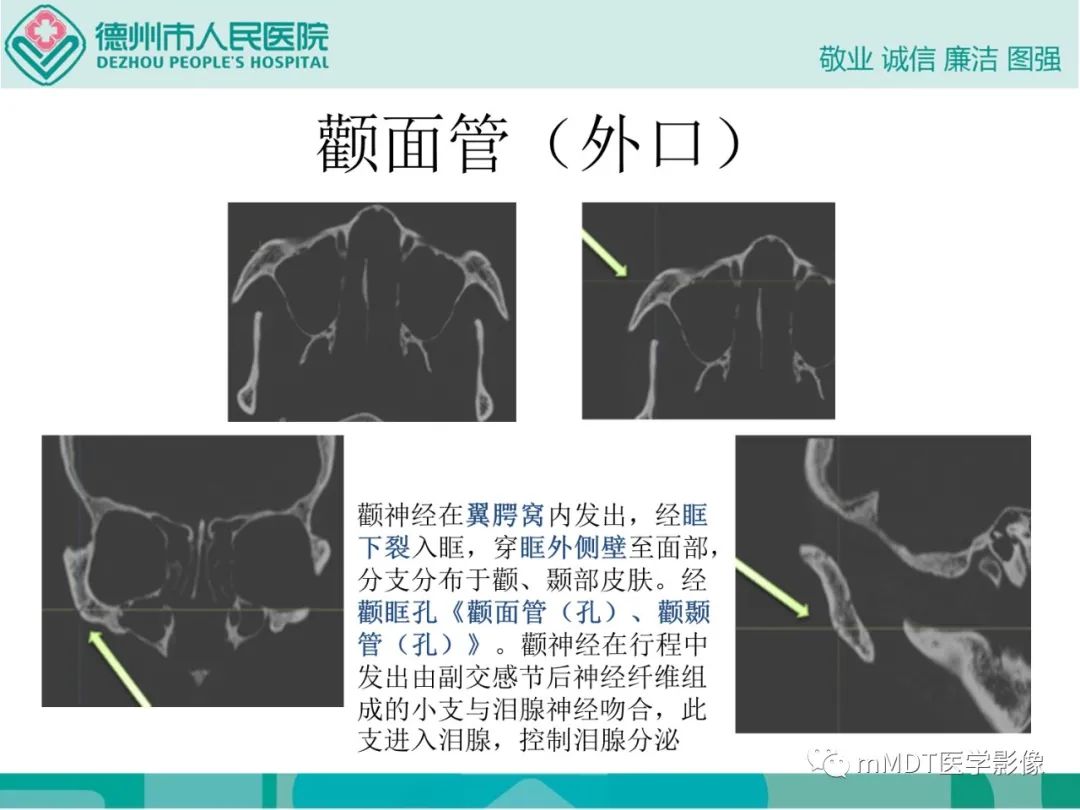影像PPT - 【PPT】绕出崎岖孔孔道—三叉神经的颅底走形-77