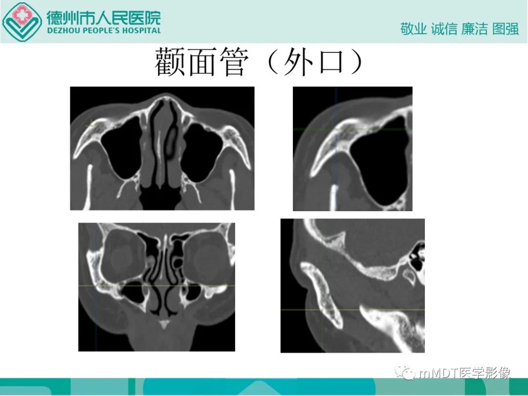 影像PPT - 【PPT】绕出崎岖孔孔道—三叉神经的颅底走形-78