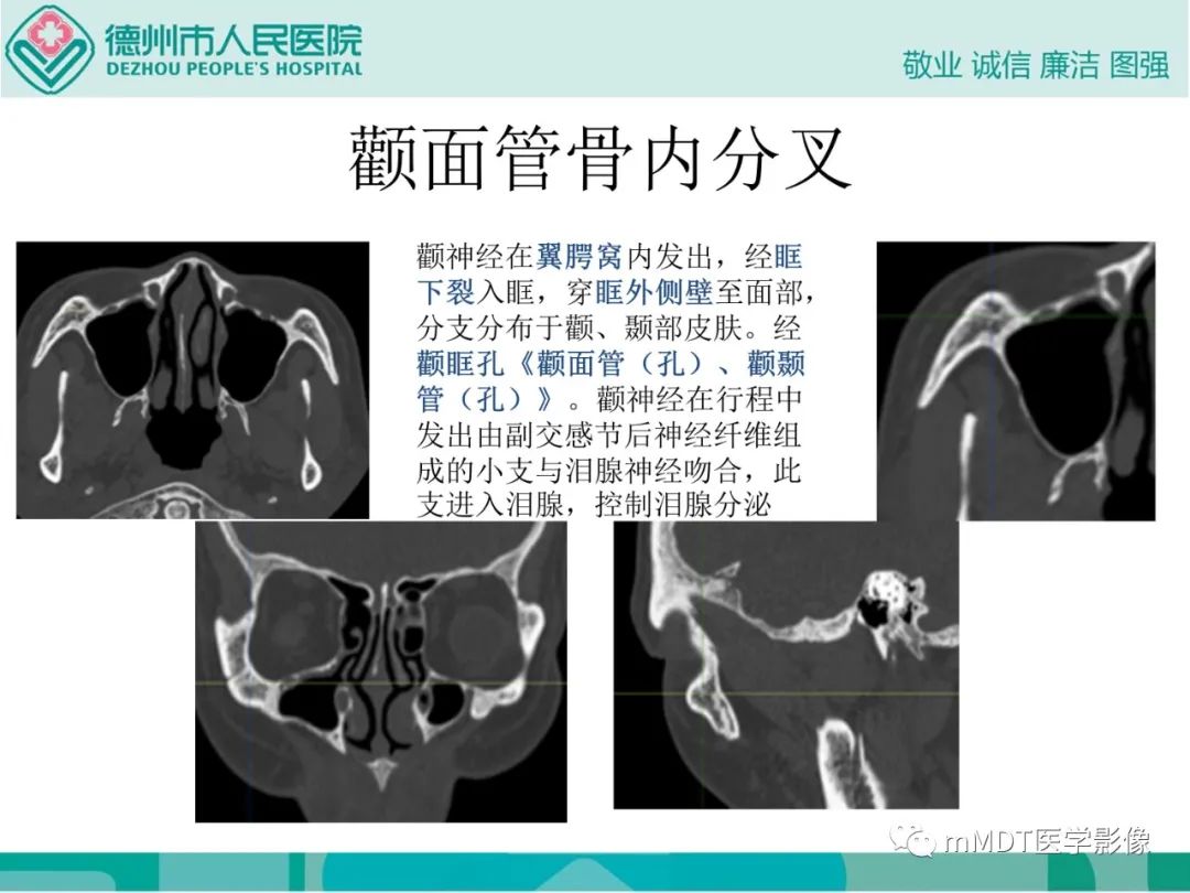 影像PPT - 【PPT】绕出崎岖孔孔道—三叉神经的颅底走形-79