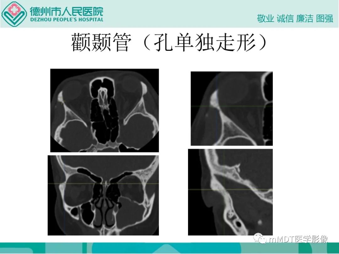影像PPT - 【PPT】绕出崎岖孔孔道—三叉神经的颅底走形-80