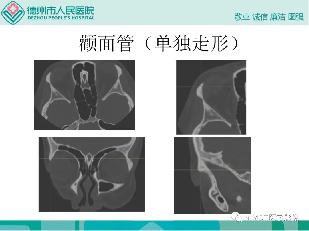影像PPT - 【PPT】绕出崎岖孔孔道—三叉神经的颅底走形-81