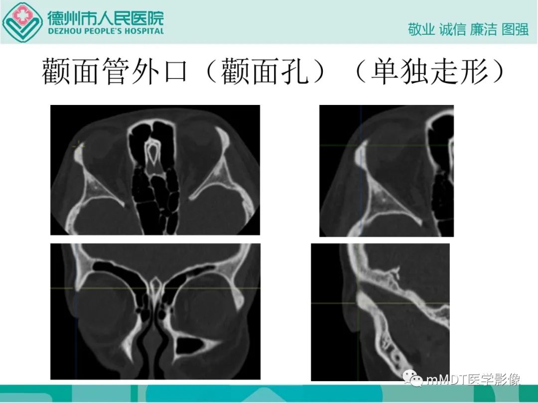 影像PPT - 【PPT】绕出崎岖孔孔道—三叉神经的颅底走形-82