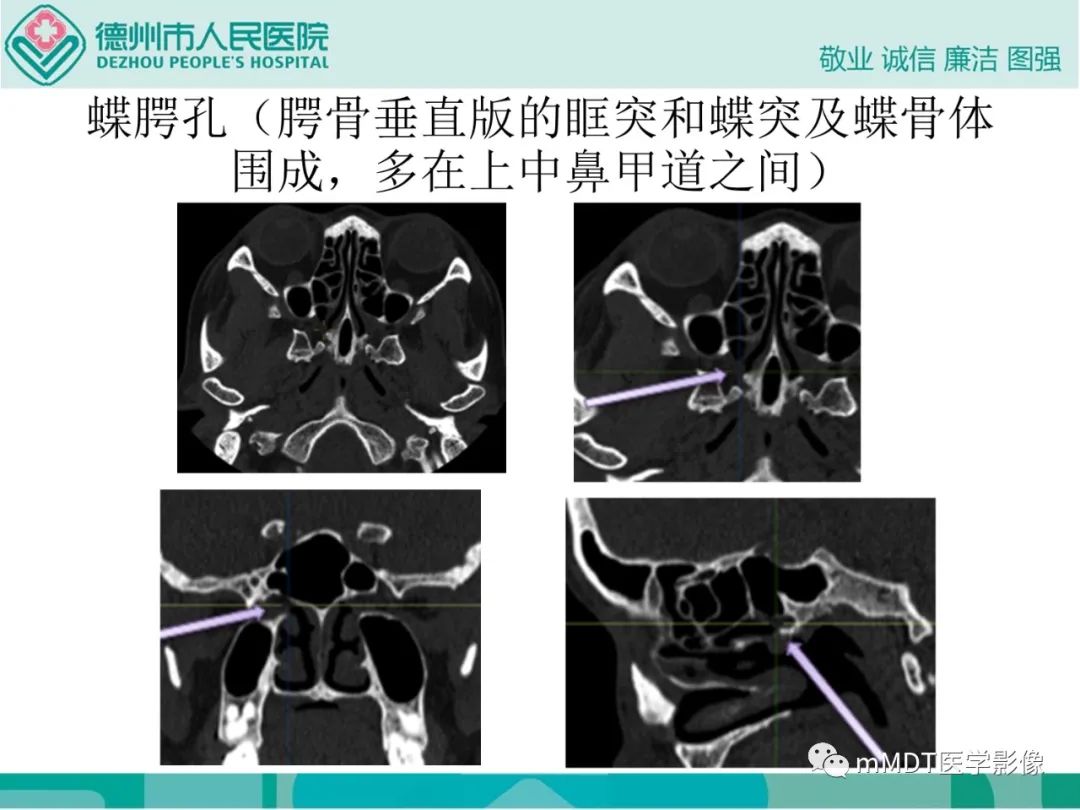 影像PPT - 【PPT】绕出崎岖孔孔道—三叉神经的颅底走形-85